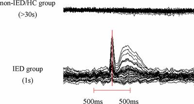 Frequency-Dependent Interictal Neuromagnetic Activities in Children With Benign Epilepsy With Centrotemporal Spikes: A Magnetoencephalography (MEG) Study